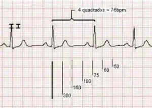 frequencia_irregular_ecg-300x214.webp