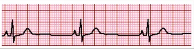 frequencia_ecg.webp